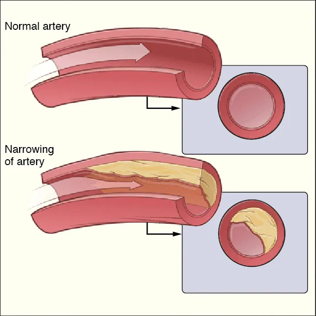 Cutaway diagram of a blood vessel showing a smooth interior, labeled normal artery. Another cutaway diagram in which vessel is partially obstructed with a yellowish substance, labeled narrowing of artery.