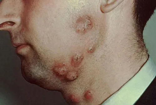 Close-up of a man's face and neck, revealing multiple inflamed, raised lesions or nodules, potentially indicative of a severe skin condition like bacterial folliculitis or deep acne along the beard line.
