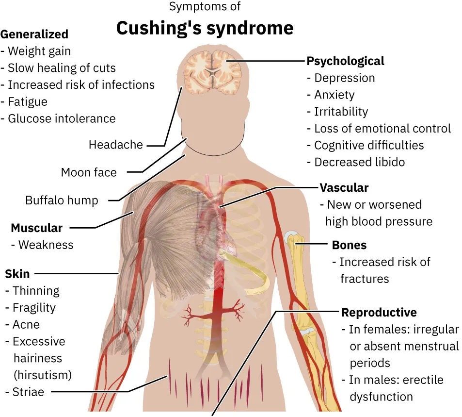 Illustration of Cushing’s syndrome symptoms: Generalized, Psychological, Vascular, Muscular, Bones, Skin, Reproductive.
