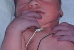 Photo of infant with splotches on their face and body with a bluish tint to their skin.