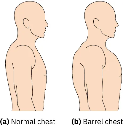 A two-panel illustration shows (a) a normal chest and (b) a barrel chest.