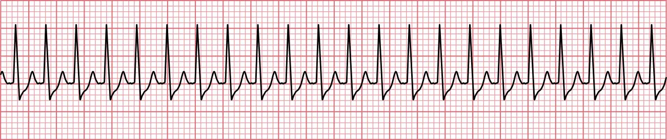 Sinus rhythm showing P waves difficult to distinguish.