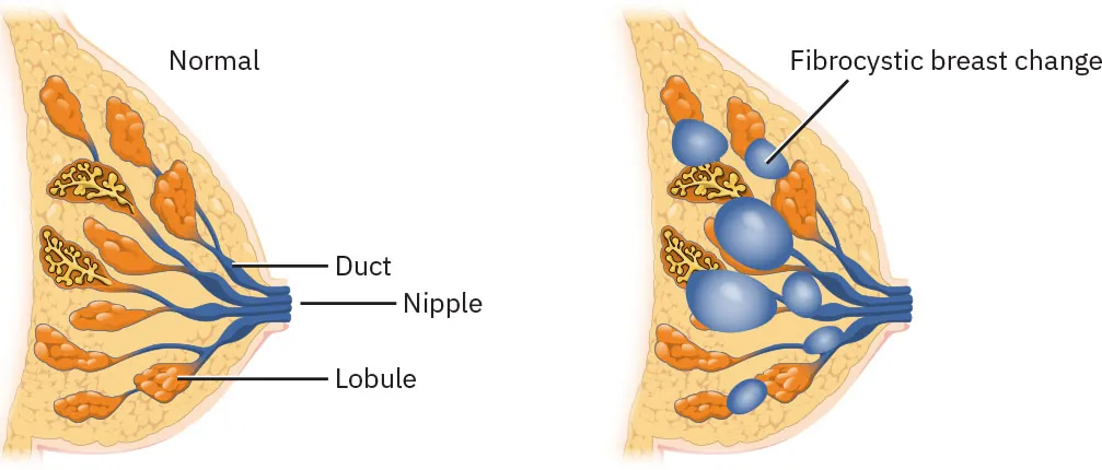 Image of normal slice of breast at left with Duct, Nipple, and Lobule labeled. At right, image displays Fibrocystic breast change with swollen ducts and slightly enlarged breast.
