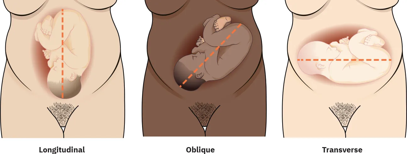 Diagram of fetal lie showing longitudinal, oblique, and transverse.