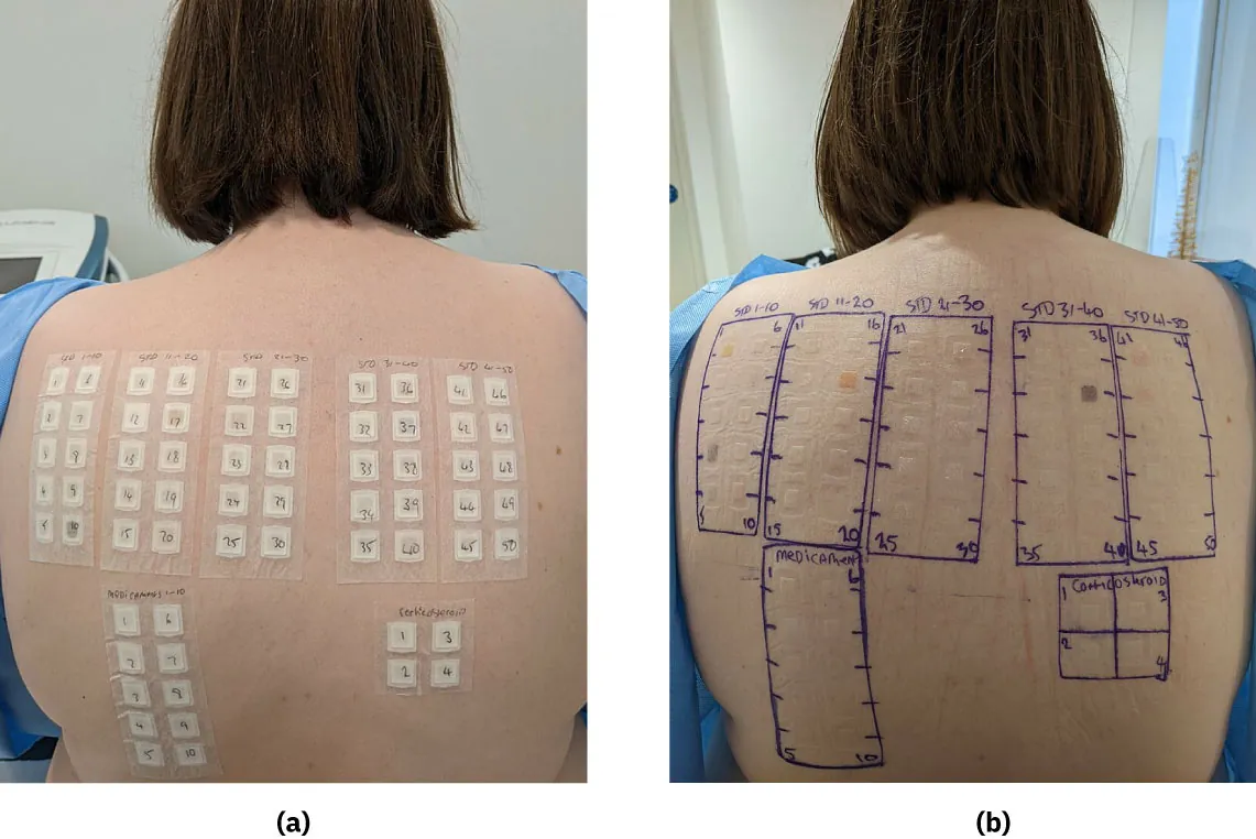 Photo of (a) variety of allergen patches placed in columns on individual’s back and (b) red marks on individual’s back indicating reactions to allergen patches, with marking indicating what allergens were placed.