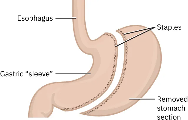 Illustration of gastric sleeve, with labels for Esophagus, Gastric "sleeve," Staples, and Removed stomach section.