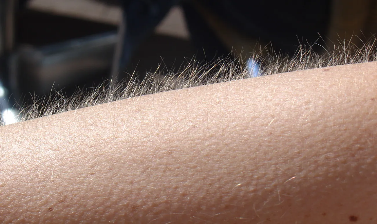 A photograph of an arm showing goosebumps
