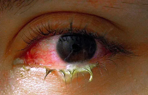 A photo of a red eye with discharge due to conjunctivitis.