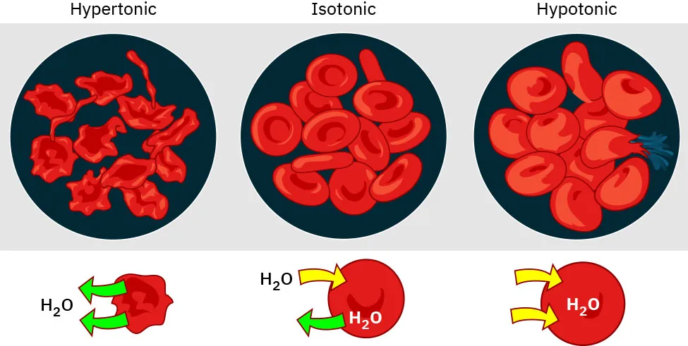A color graphic showing hypertonic fluids, hypotonic fluids, and isotonic fluids. The hypertonic fluid depicts blood cells that are shrunken and a diagram showing the flow of H20 out of the cells. The isotonic fluid depicts normal looking blood cells and shows H20 flowing in and out of the cells. The hypotonic fluid depicts swollen blood cells with a diagram showing the inflow of H20 into the cells.