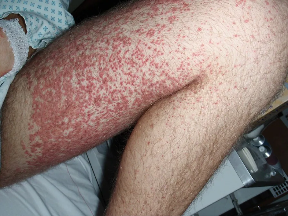 Petechiae on leg