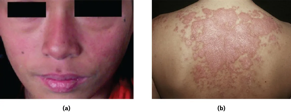 (a) Butterfly rash across the nose and cheeks that is commonly associated with SLE; (b) Discoid rash on the back