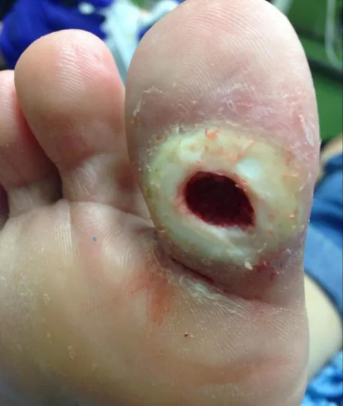 A photo of a diabetic foot ulcer in a patient’s big toe.