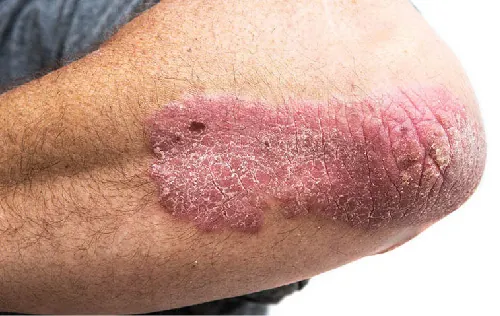 Close-up of an elbow affected by psoriasis, showing red, scaly, and inflamed skin.