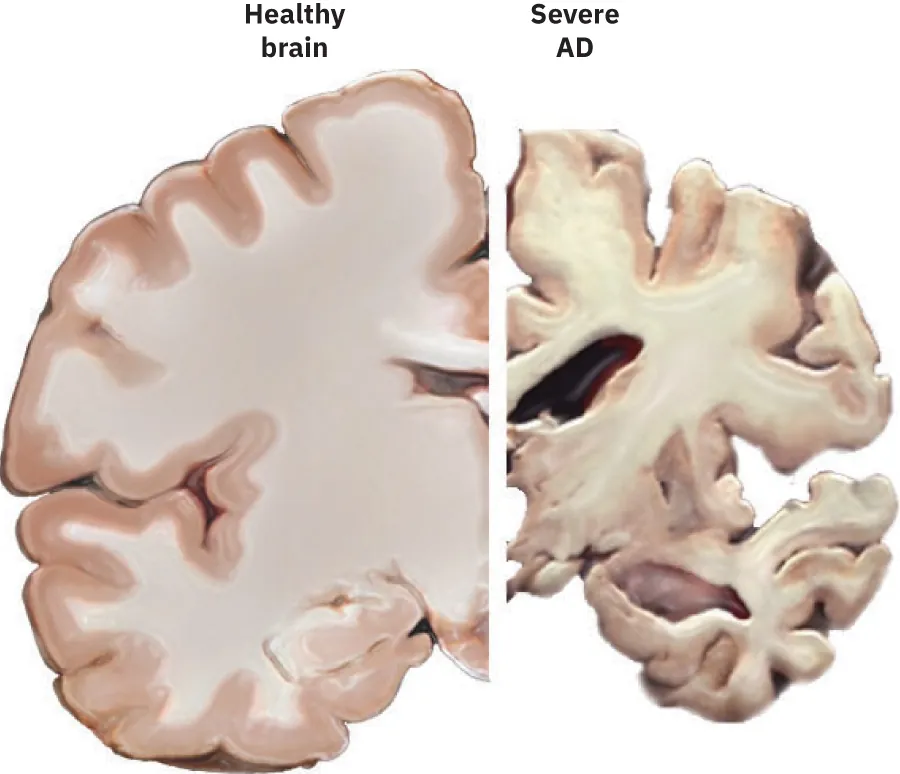 Left side of image shows slice of healthy brain. Right side of image shows slice of Severe AD brain, which is smaller and less plump.