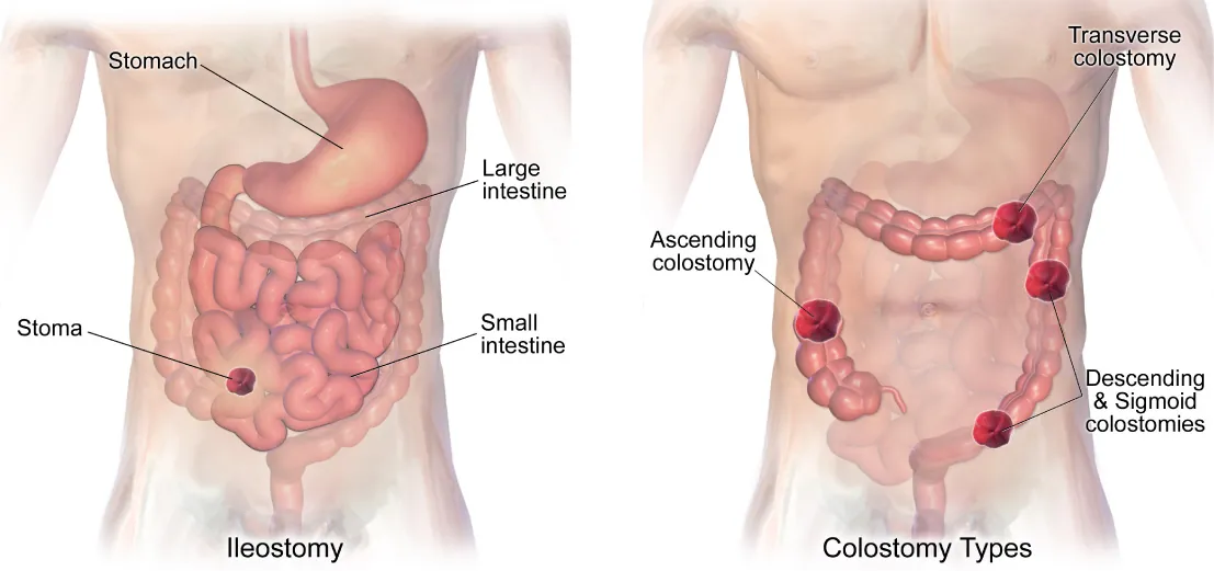 Illustration showing anatomic locations of ostomy sites: Ileostomy, labeling Stomach, Large intestine, Small intestine, and Stoma; Colostomy Types, labeling Transverse colostomy, Ascending colostomy, and Descending & Sigmoid colostomies.