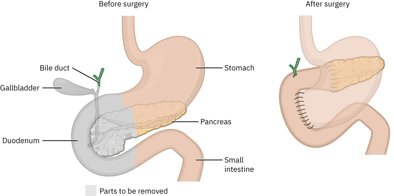 Before surgery illustration showing parts of body removed during a Whipple procedure: Bile duct, Gall bladder, and Duodenum; other labels include Stomach, Pancreas, and Small intestine; After surgery illustration also shown.