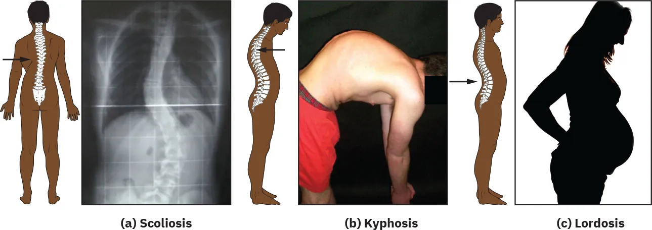 Diagram showing (a) scoliosis, (b) kyphosis, (c) lordosis