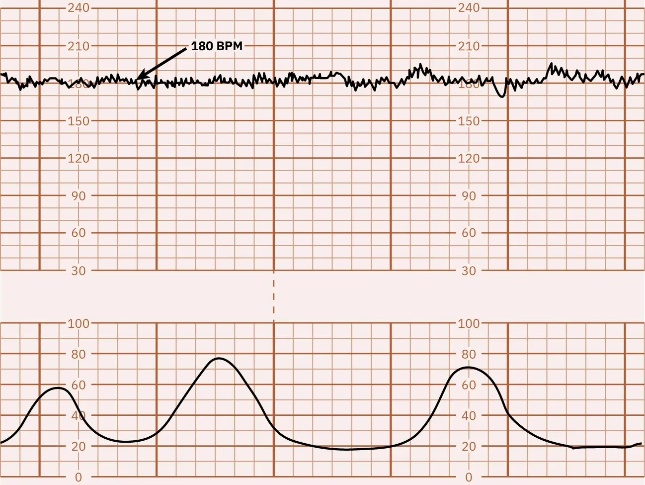 Fetal heart rate reading indicating tachycardia.