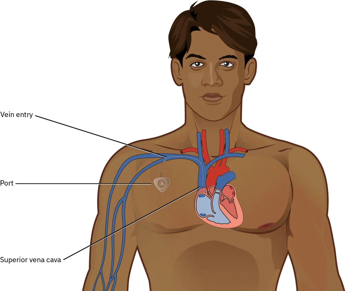 A diagram shows a head and torso with the heart and catheter shown. The labels include “port,” “vein entry,” and “superior vena cava.”