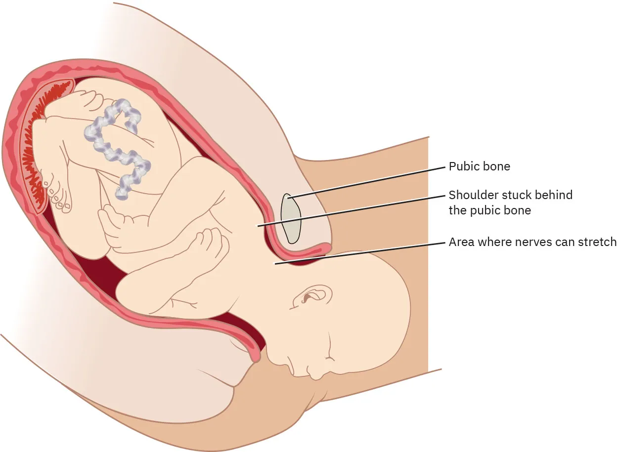 Image of fetus with head out of the birth canal while shoulder is stuck behind the public bone.
