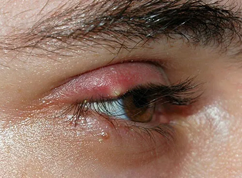 A photo of an eye with a swollen lump due to hordeolum.