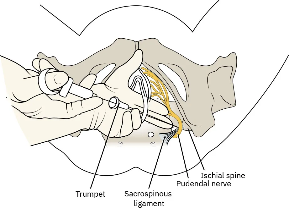 Diagram showing insertion of pudendal block (with trumpet labeled) under ischial spine between pudendal nerve and sacrospinous ligament.