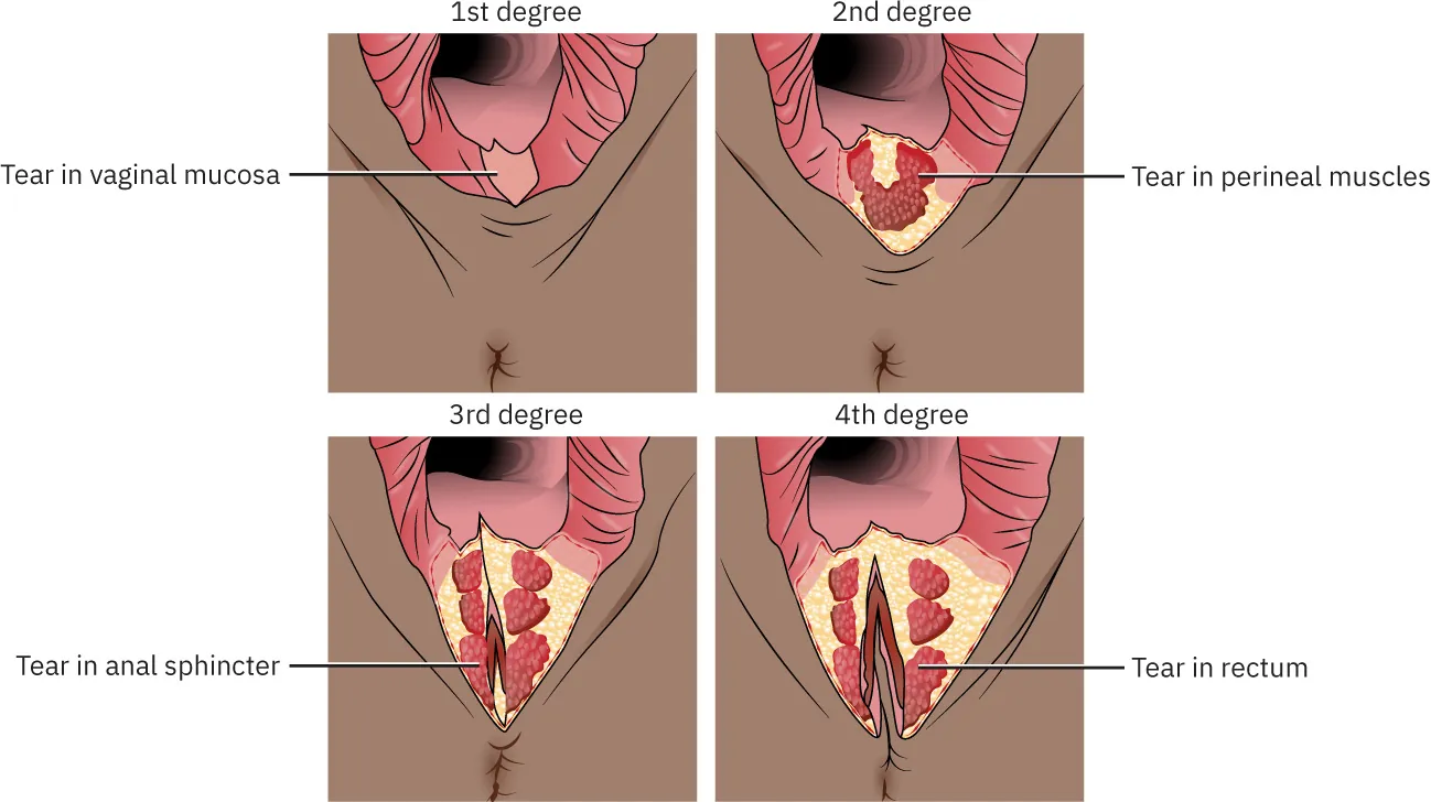 Diagram showing degrees of perineal lacerations: 1st degree showing vaginal mucosa torn with anus visible, 2nd degree showing perineal muscles torn, 3rd degree showing anal sphincter torn, 4th degree showing rectum torn.