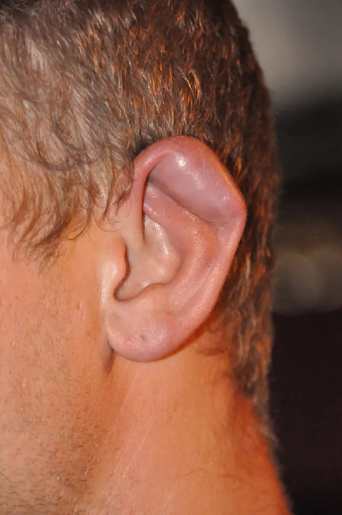 A photo of a man’s ear deformity of the auricle.