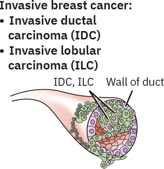 Image of IDC and ILC in the breast duct.