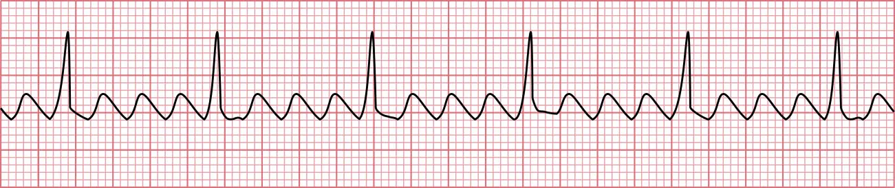 Sinus rhythm showing sawtooth pattern classic of atrial flutter.