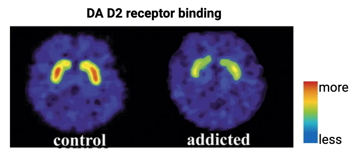 Example human brain PET scans show more DA D2 receptor binding in control versus addicted brains. This demonstrates reduced expression of D2 dopamine receptors within the basal ganglia of participants with cocaine use disorder compared to controls.