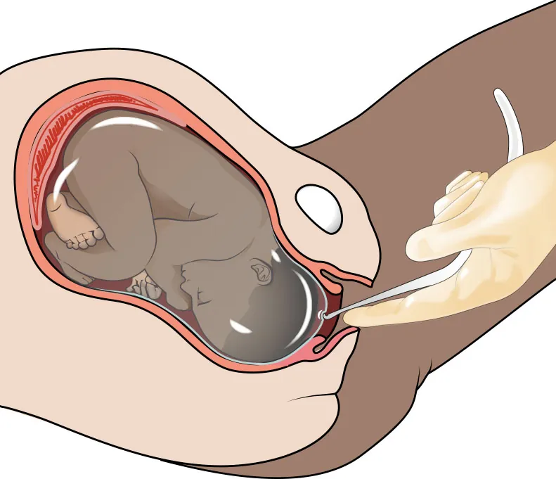 Diagram showing health care provider using amniotomy hook to rupture amniotic sac.