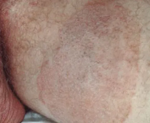 Close-up of skin with an extensive, irregular, reddish patch and visible hair, suggesting a dermatological rash or inflammation.