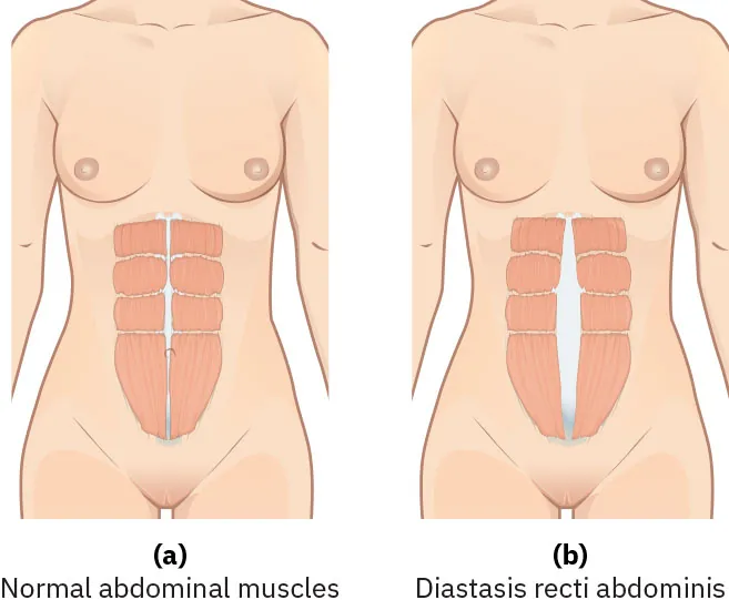 Image of (a) normal abdominal muscles with little distance between muscles and (b) diastasis recti abdominis muscles which are separated down the middle.