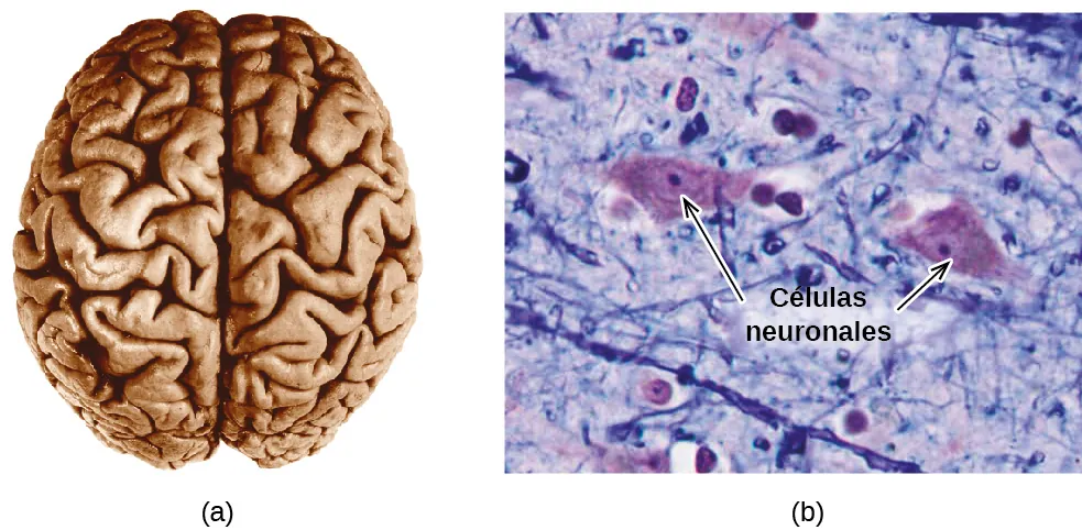 Se muestran dos imágenes. La imagen de la izquierda muestra el cerebro humano. La imagen de la derecha es una imagen microscópica que muestra dos grandes masas de forma irregular en un campo de material filiforme intercalado con masas más pequeñas y relativamente redondas. Las dos masas más grandes están marcadas con flechas y la frase "Células neuronales”.