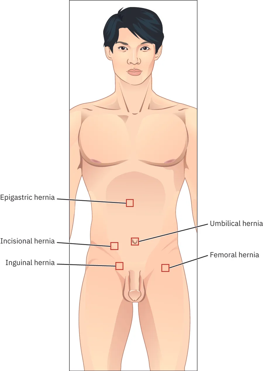 Graphic showing the different areas of the body in which hernias can occur
