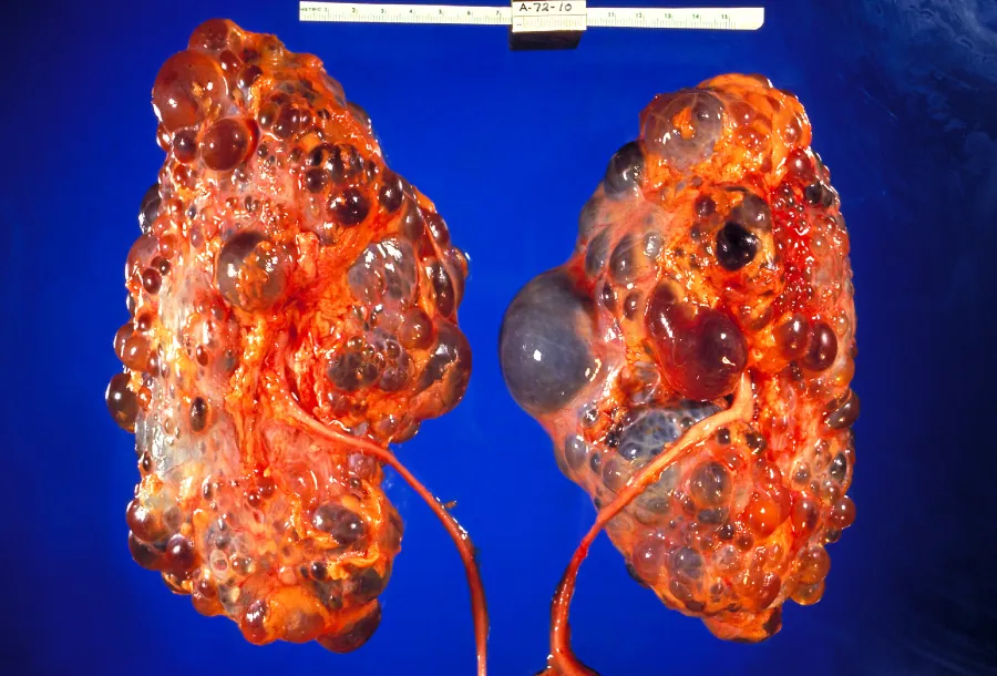 A clinical photograph showing two kidneys affected by polycystic kidney disease (PKD). The kidneys are enlarged and covered with numerous cysts of varying sizes, giving them a bumpy and swollen appearance. The image is set against a blue background.