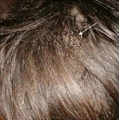 Close-up of hair with a severe infestation of lice and nits, clearly visible throughout the strands and scalp, indicated by an arrow pointing to a dense cluster.