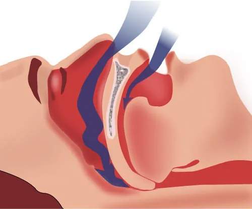 Image of nasal and throat passages in individual laying down with mouth open. Arrows depicting air going into the nose and mouth are blocked with structures in the mouth (ie: tongue, soft palate, and sides of the throat) closing off the throat, preventing air flow.