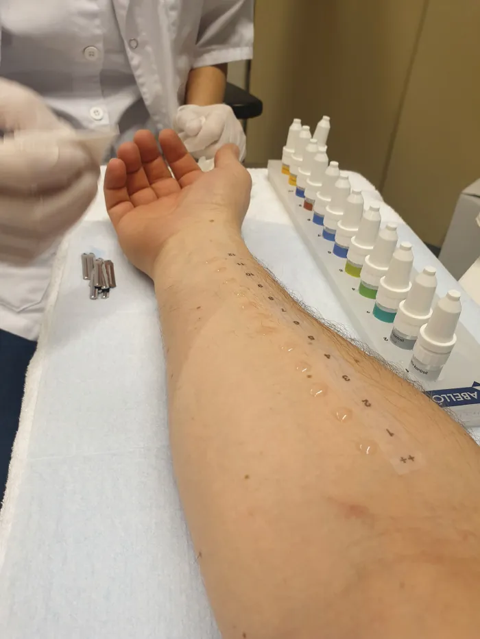 A photograph shows a healthcare provider applying an allergy skin test to a patient's arm.