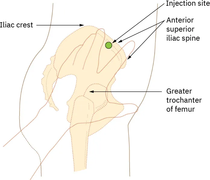 A diagram shows how to locate ventrogluteal site, labeling iliac crest, injection site, anterior superior iliac spine, greater trochanter of femur.