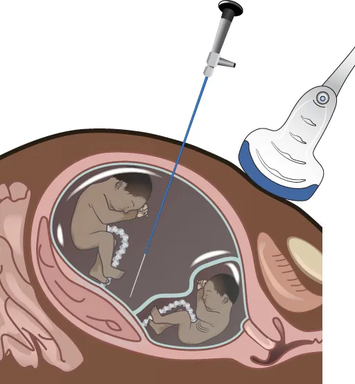 Image of pregnant person with two fetuses in utero. Ultrasound wand visible on abdomen and laparoscope is being inserted into the abdomen, going into the uterus.