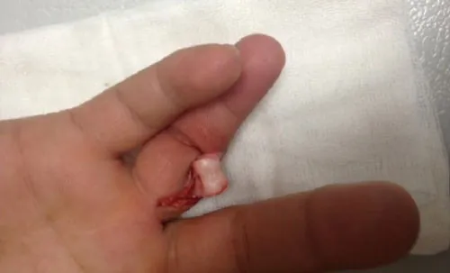 Example of an unintentional wound – open dislocation of a finger.