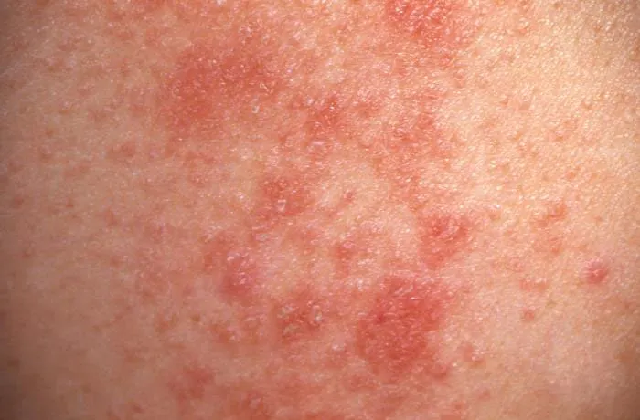 Erythema