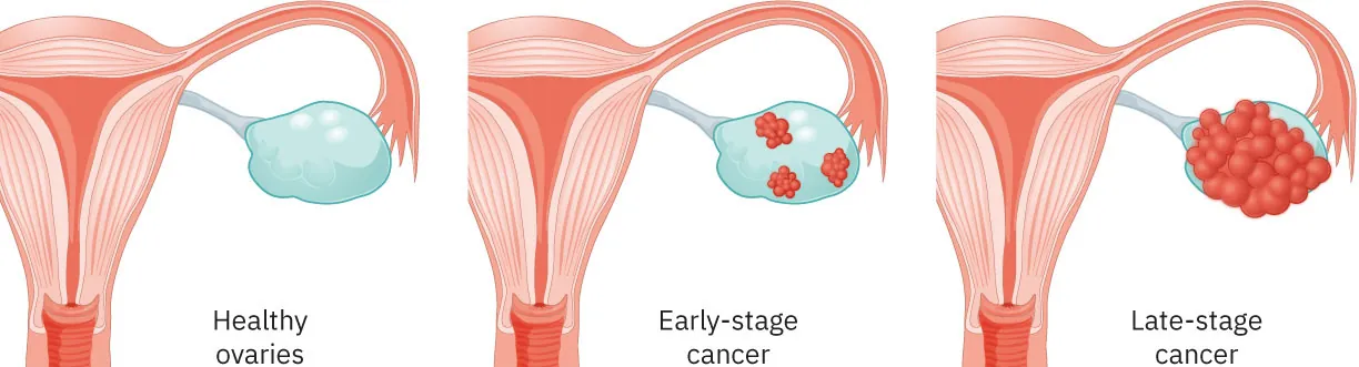 Images of healthy ovary (no outside growths), early-stage cancers (small clumps of round cells growing on outside of ovary), and late-stage cancer (large, circular clumps of cells growing on outside of ovary).