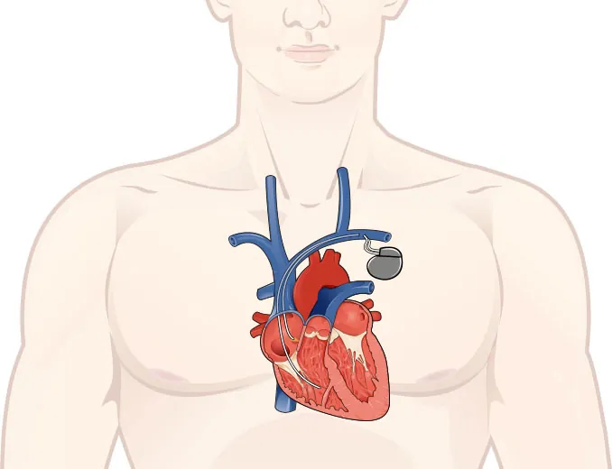  Diagram showing pacemaker with wires threaded into veins to heart.