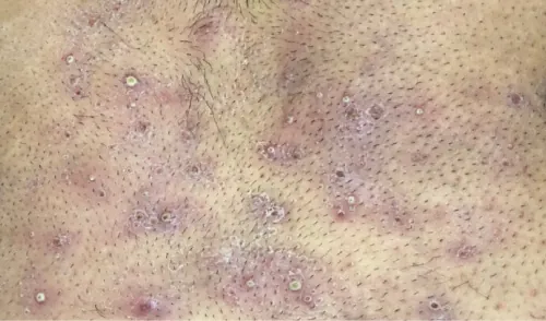 A color photograph of folliculitis shown.