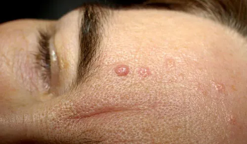 Seborrheic dermatitis