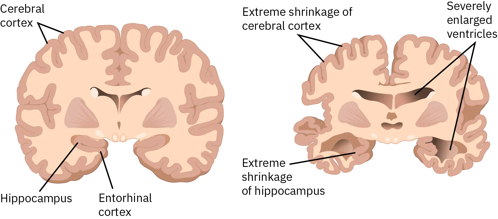 A cross-section of a normal brain and the brain of an Alzheimer's patient are compared. In the brain with Alzheimer's, the cerebral cortex is greatly shrunken in size, as is the hippocampus. Ventricles in the center and bottom right and left parts of the brain are also enlarged.