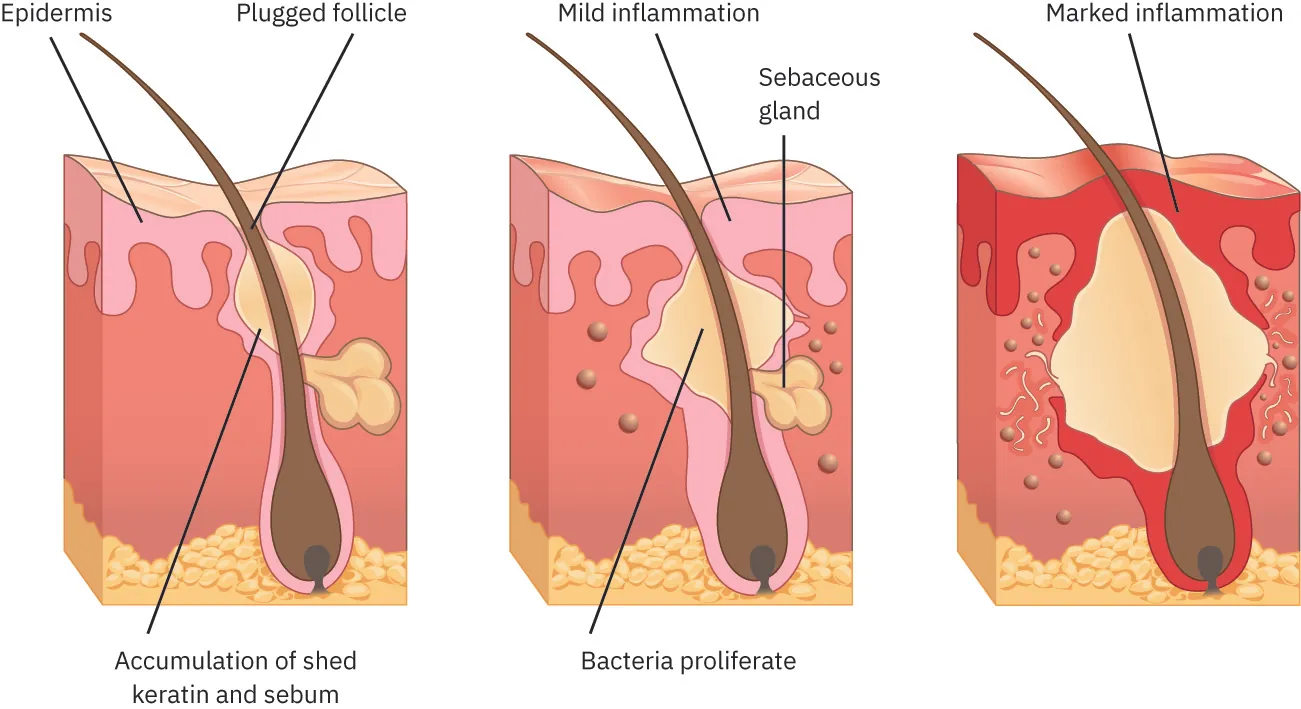 Three diagrams of acne with labels showing epidermis, plugged follicle, accumulation of shed keratin and sebum, mild inflammation, sebaceous gland, bacteria proliferate, and marked inflammation